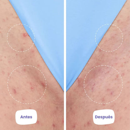 Axilina™ - Piel suave, sin bultos ni manchas después de depilarte